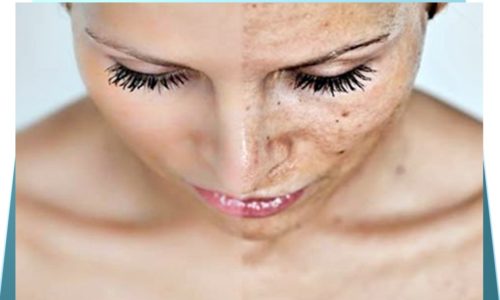 Figura de Mulher com pele antes e depois aplicação do ácido tranexâmico