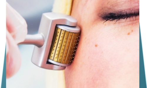 microagulhamento e drug delivery imagem de mulher utilizando um dermaroller