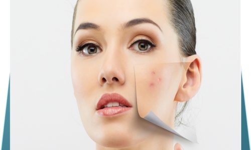 acne2